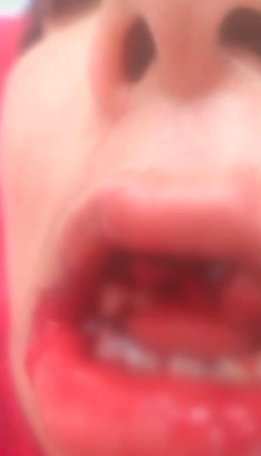Cadeirante com paralisia cerebral quebra dentes após cair de elevador de ônibus no Terminal Praça A
