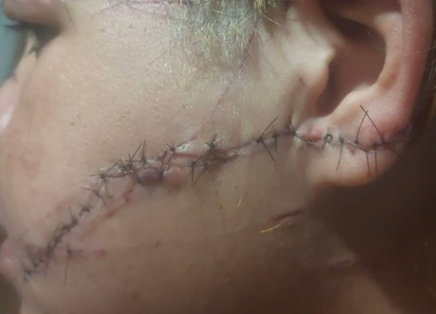 Homem corta rosto e orelha de ex-mulher e é preso; suspeito era procurado por feminicídio